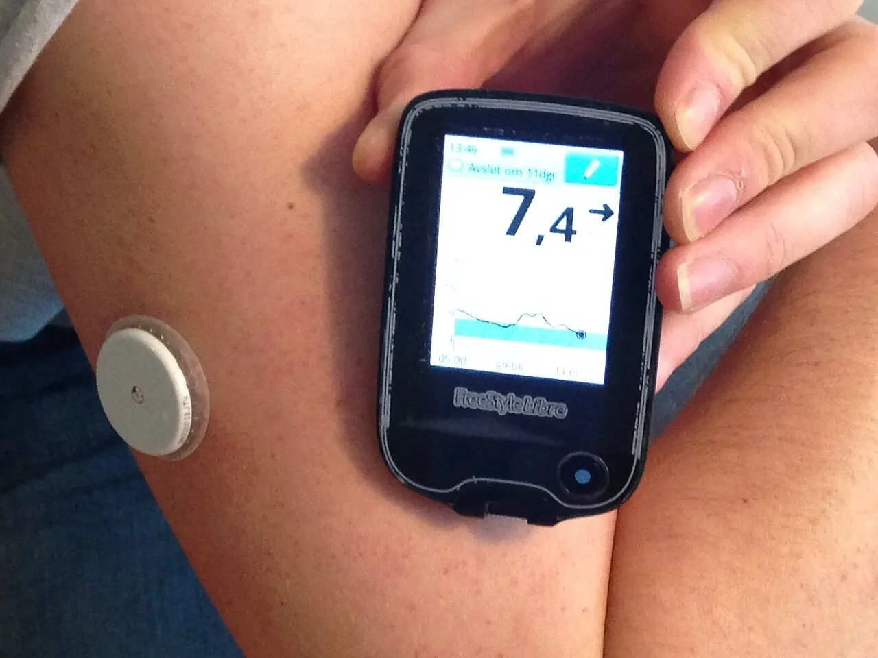 Glucose sensor on an upper arm next to its handheld reader